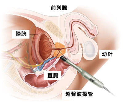 前列腺癌会引起男性乳