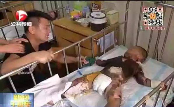 男童跌入开水盆奶奶摸碱急救造成二次伤害 少儿