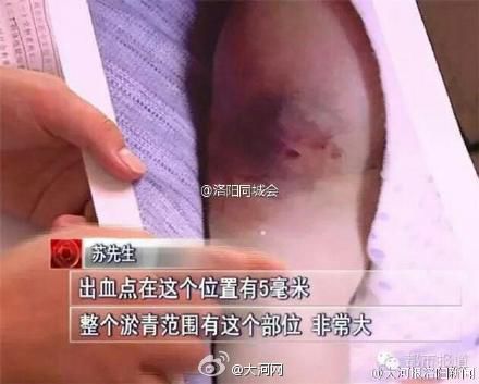 河南40天男婴接种疫苗死亡 接种禁忌不得不知