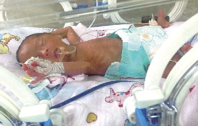 郑州三胞胎姐妹仅有巴掌大 全身皮肤发皱似透明