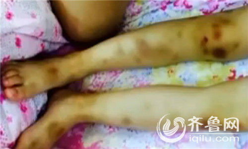 济南一个3岁大的小女孩腿上、腰上、胳膊上伤痕累累,让人看了触目惊心。孩子说是保姆拧的,可保姆却不承认。