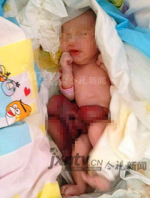 景德镇一婴儿出生肠子外翻一天后死亡 多次孕检