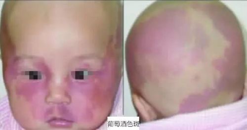 胎记也有“好”有“坏”!教你如何区分