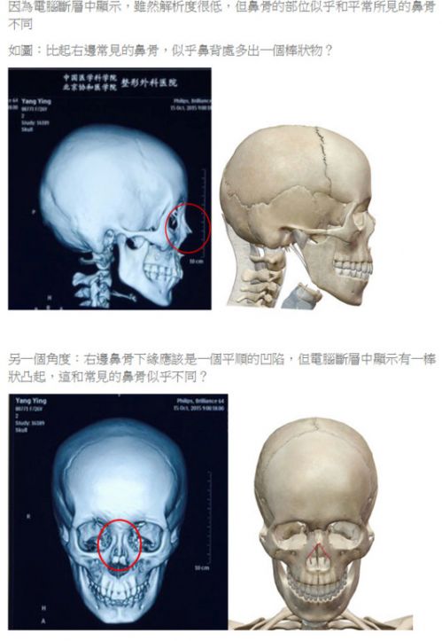 baby面部鉴定结果遭专家质疑:鼻骨有棒状物